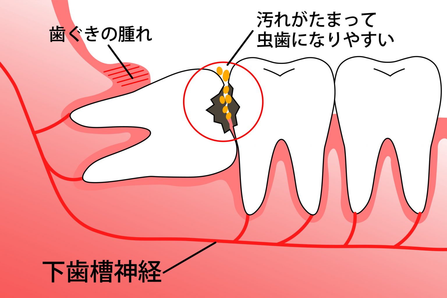 親知らず 抜歯 後 腫れ いつまで