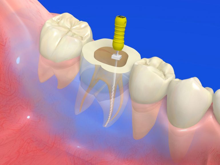 根管充填とは