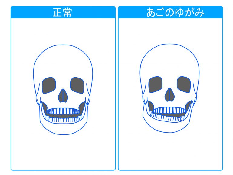 顎関節症の原因