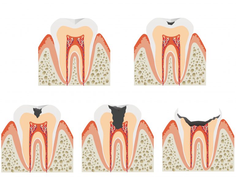 むし歯の進行と症状・治療法